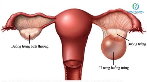 Bị u nang buồng trứng có thai được không?
