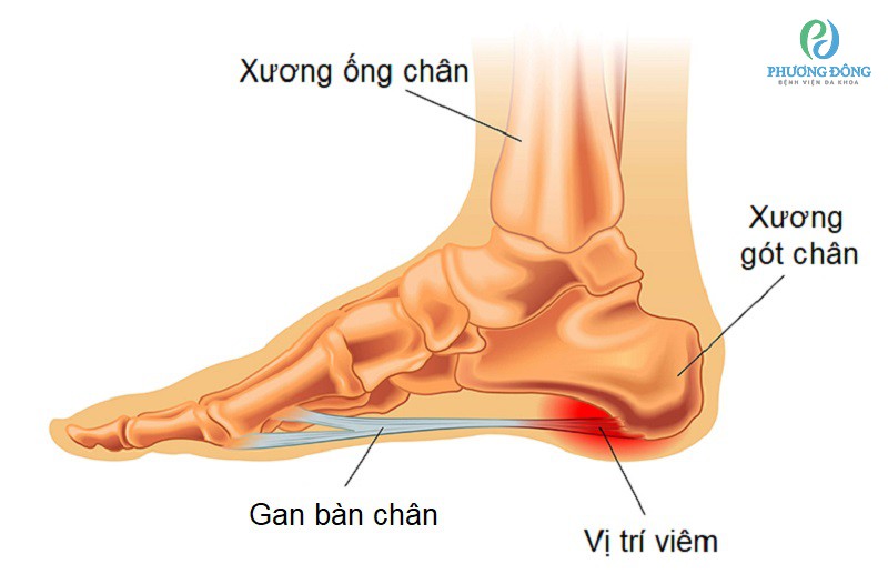 Viêm cân gan bàn chân gây ra những cơn đau bất chợt, ảnh hưởng đến sinh hoạt người bệnh