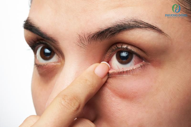 Mắt có cảm giác bị cộm như bị mắc dị vật là một triệu chứng thường thấy khi khô mắt
