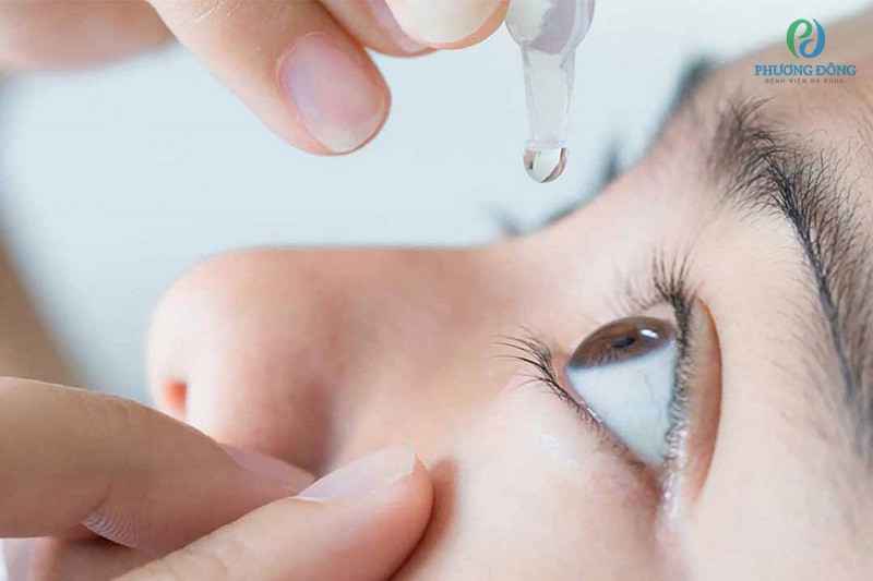 Sử dụng thuốc nhỏ mắt để giảm khô mắt mỏi mắt