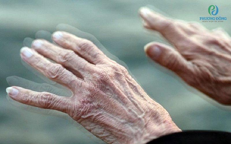 Người cao tuổi có nguy cơ mắc bệnh Parkinson