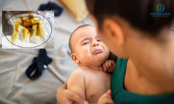 Cách nhận biết phân của trẻ sơ sinh bị tiêu chảy và hướng xử lý