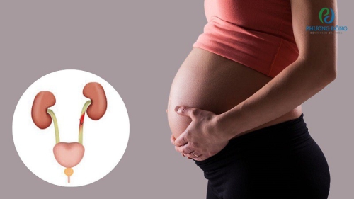 Viêm đường tiết niệu khi mang thai - Biến chứng khôn lường