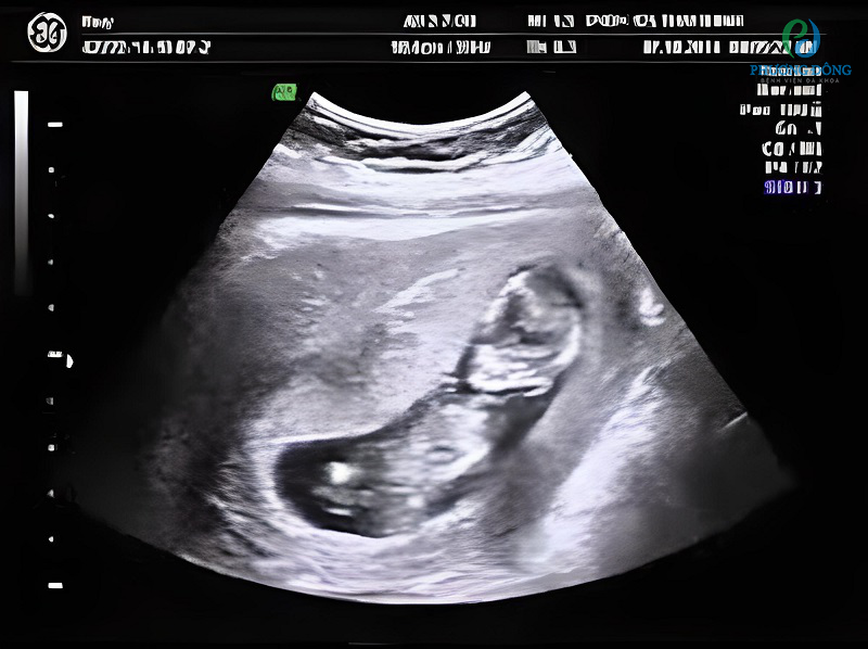 Hình ảnh siêu âm của thai nhi ở tuần 12  