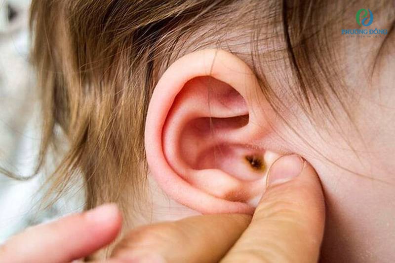 Vành tai bé bị sưng đỏ có thể đến từ nguyên nhân bé bị viêm tai ngoài