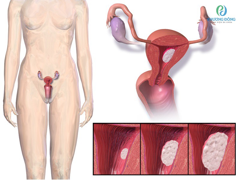 U nang buồng trứng là một trong số nguyên nhân gây bệnh xoắn ở buồng trứng