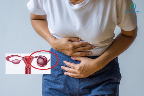 Xoắn buồng trứng: Dấu hiệu, nguyên nhân và phương pháp điều trị