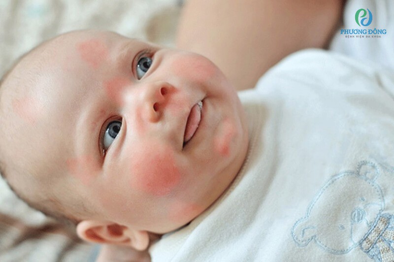 Trẻ nhỏ với làn da mỏng manh và hệ miễn dịch kém rất dễ bị dị ứng thời tiết