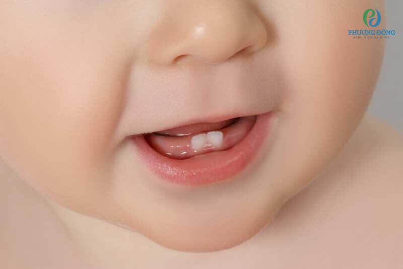 Trẻ chậm mọc răng có thể do yếu tố di truyền hoặc chế độ ăn thiếu chất
