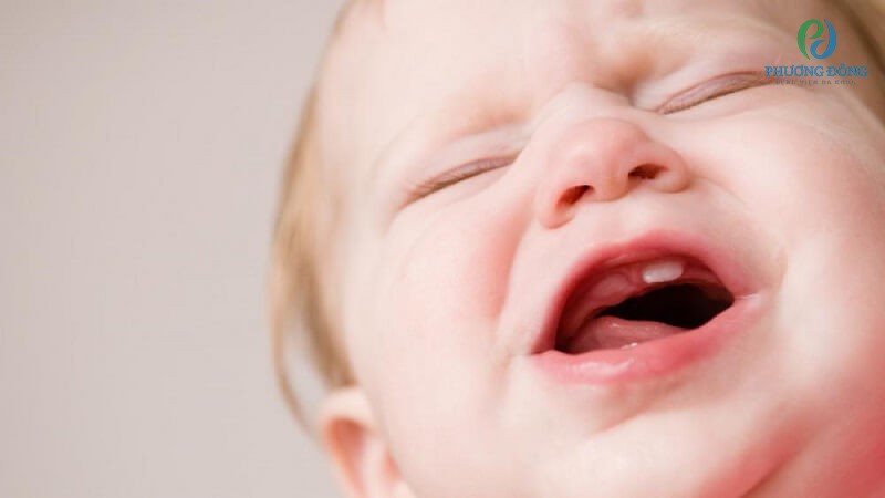 Trẻ bị sốt do mọc răng kèm theo chảy dãi nhiều