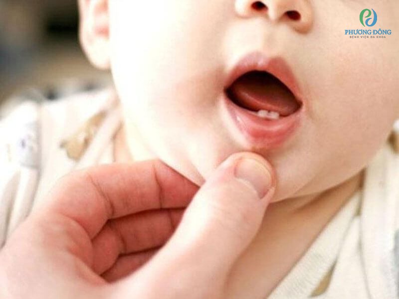 Trẻ sốt mọc răng có sự khác biệt với sốt do bệnh lý