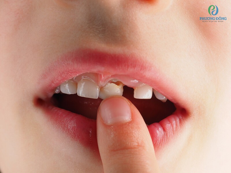 Không nên tự nhổ răng tại nhà cho bé