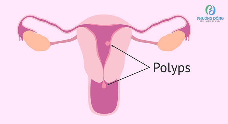 Nguyên nhân gây ra polyp buồng tử cung chưa được xác định rõ ràng