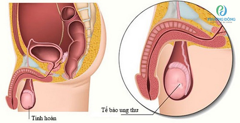 Viêm nhiễm hệ sinh dục cũng gây tắc nghẽn ống dẫn tinh