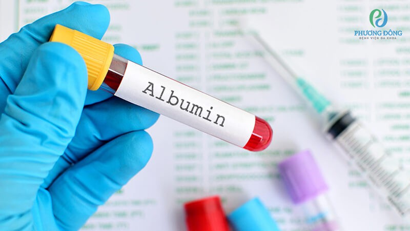 Xét nghiệm Albumin huyết thanh để đánh giá chức năng tổng hợp