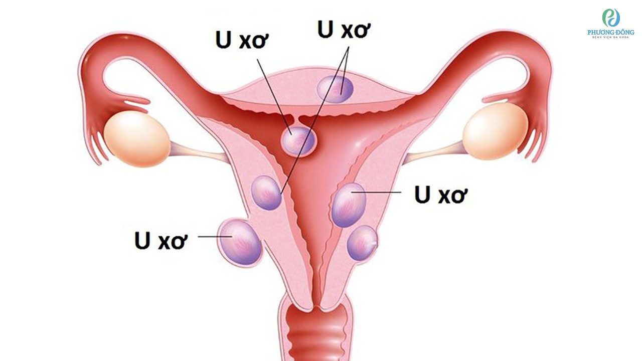 Người mắc bệnh về u xơ tử cung phải thực hiện cắt tử cung toàn phần