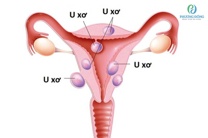 U xơ tử cung giai đoạn nặng cần cắt bỏ sớm để tránh gây đau đớn cho bệnh nhân