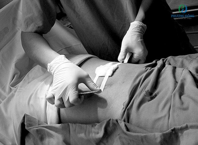 Bệnh nhân có thể gặp phải một số biến chứng sau khi phẫu thuật cắt tử cung
