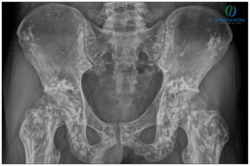 Chụp x-quang xương chậu và cột sống 