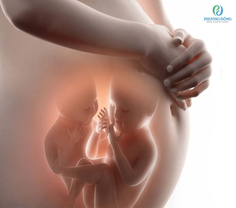 Mang đa thai làm gia tăng nguy cơ bị đa ối cần được can thiệp sớm
