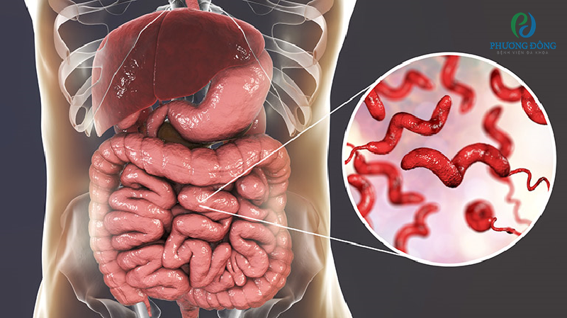 Vi khuẩn xâm nhập làm cho dạ dày ruột bị viêm.