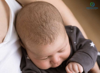 Viêm da tiết bã ở trẻ sơ sinh có nguy hiểm không? Làm sao để khỏi?