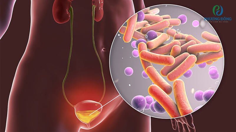 E.coli là tác nhân chính gây viêm đường tiết niệu