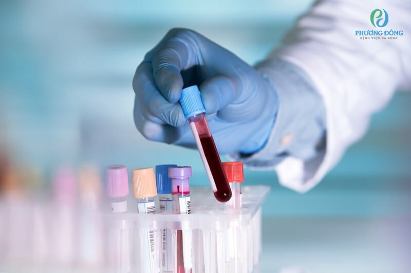Xét nghiệm máu tìm kháng thể để kết luận tình trạng bị viêm gan A