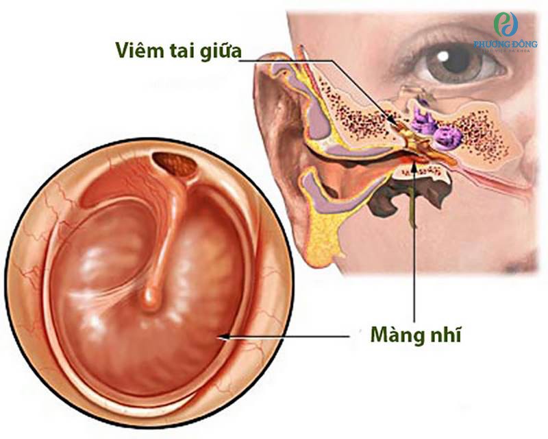 Bệnh viêm tai giữa có thể lây qua đường mũi họng 
