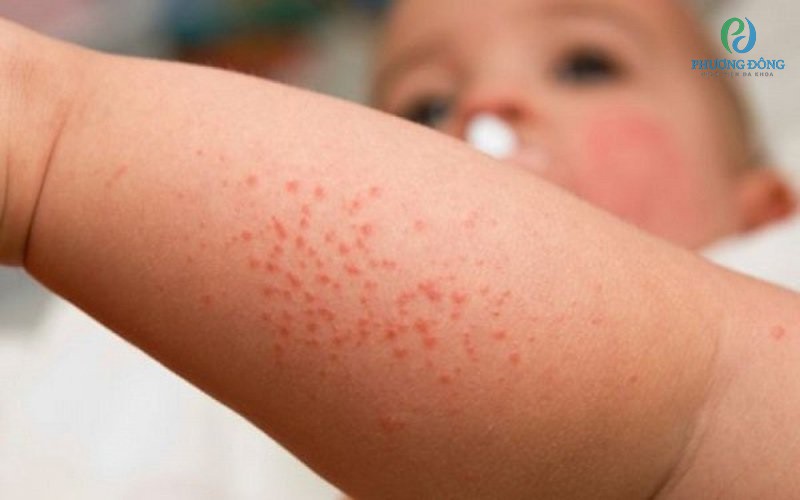 Trẻ bị xuất huyết giảm tiểu cầu thường xuất hiện các đốm/ mảng đỏ tím trên da