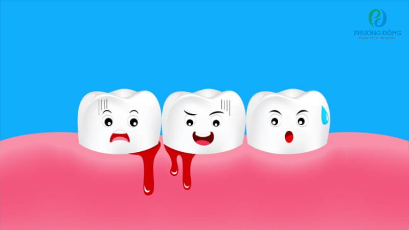 Chảy máu chân răng là một triệu chứng lâm sàng của bệnh giảm tiểu cầu