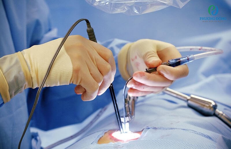Phương pháp cắt lách có độ an toàn và tỷ lệ đáp ứng lâu dài cao.