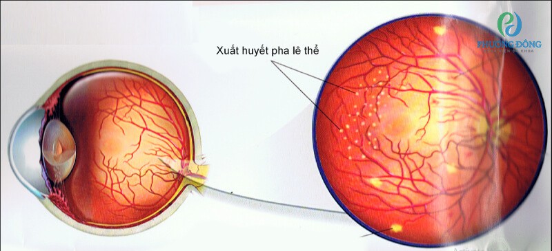 Tình trạng chảy máu từ trong mạch máu của võng mạc thoát ra ngoài ảnh hưởng đến thị lực của người bệnh