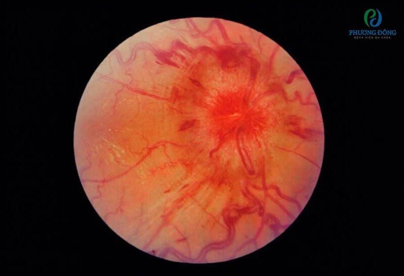 Soi đáy mắt để kiểm tra tổn thương và chẩn đoán võng mạc bị xuất huyết