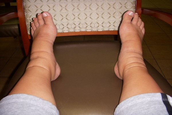 Nguyên nhân khiến chân bị phù khi mang thai