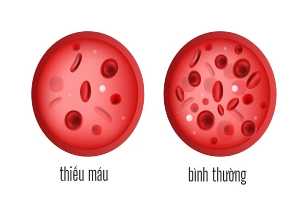 Thiếu máu là bệnh lý liên quan đến hồng cầu