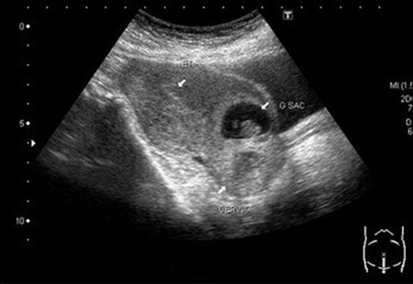 Hình ảnh siêu âm cho thấy túi thai không nằm trong tử cung.