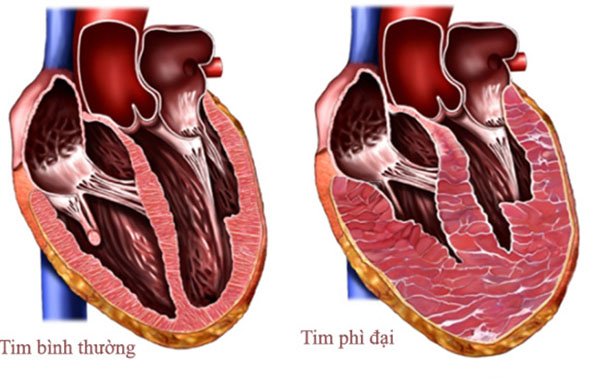 Hình ảnh mô tả cơ tim khi bị phì đại so với trạng thái bình thường.