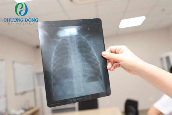 Chụp X-quang ngực thẳng để phát hiện các bất thường trong hô hấp