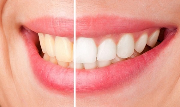Đúng như tên gọi, kem tẩy trắng răng giúp răng trắng sáng, đều màu hơn