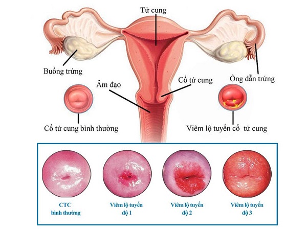 Các cấp độ viêm lộ tuyến tử cung
