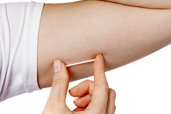 Que tránh thai nhỏ, chất liệu dẻo thường được đặt dưới da cánh tay không thuận.