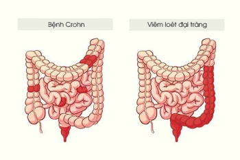 Bệnh Crohn: Nguyên nhân, triệu chứng, điều trị và cách phòng tránh