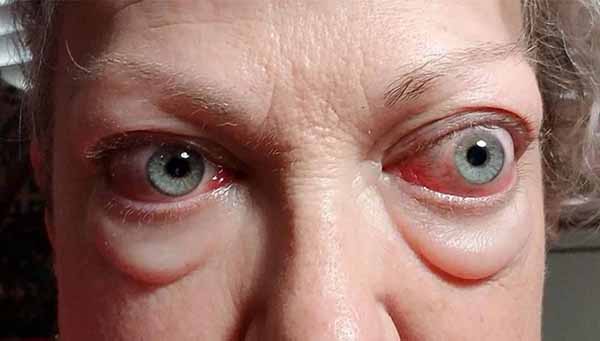 Biểu hiện mắt lồi to rất đặc trưng ở bệnh nhân mắc basedow