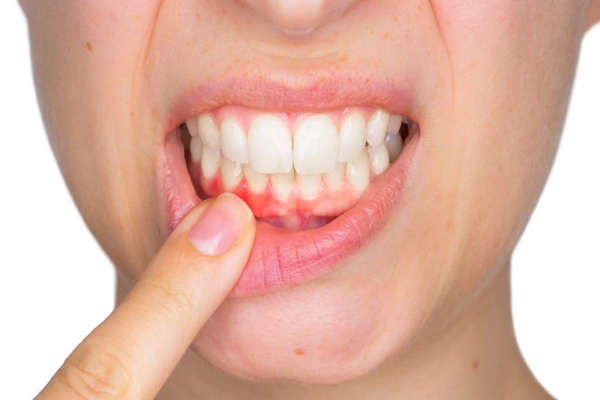Không đánh răng sẽ khiến vi khuẩn xâm nhập gây các bệnh về răng miệng
