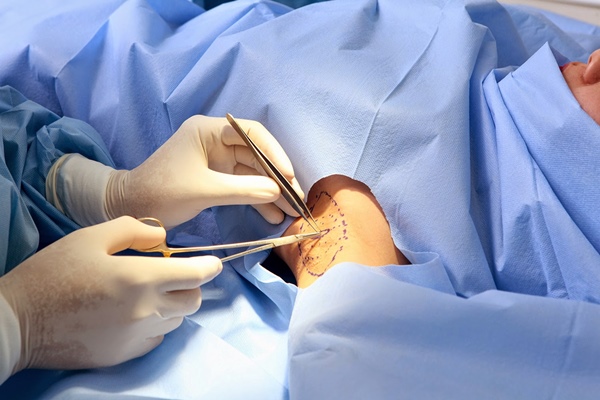 Tiểu phẫu cắt bỏ u là cách điều trị bệnh hiệu quả nhất