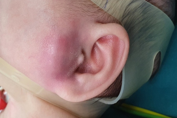 Nhọt ống tai ngoài có thể tự khỏi nhưng dễ tái phát