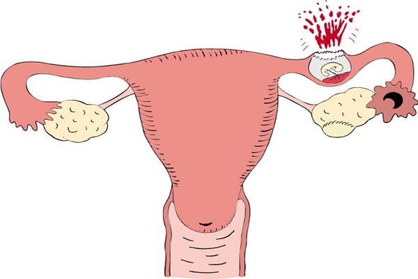 Thai ngoài tử cung còn gọi là chửa ngoài tử cung, chửa ngoài dạ con
