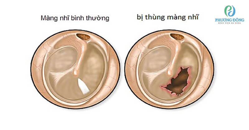 Thủng màng nhĩ là tình trạng lớp màng ngăn cách phần tai giữa và ngoài bị rách