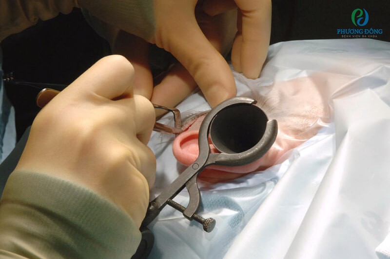 Sử dụng hai phương pháp: dùng thuốc và vá màng nhĩ để chữa bệnh màng nhĩ bị thủng